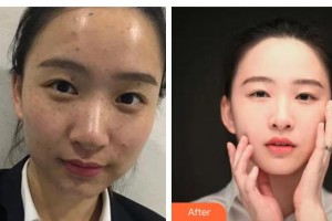 唐山市人民醫(yī)院燒傷整形科謝學峰整形價格表附激光祛斑案例展示