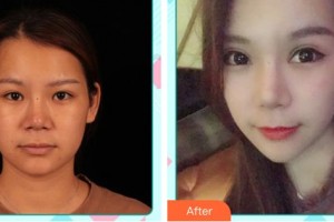 唐山市人民醫(yī)院燒傷整形科馮玉柱整形價(jià)格表附眼部綜合案例展示