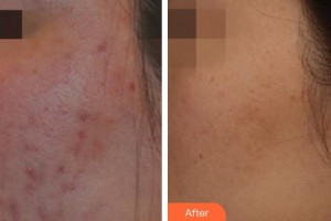 唐山市人民醫(yī)院燒傷整形科陳錚住院醫(yī)師整形價格表附清潔祛痘案例展示