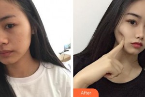 唐山惠美登醫(yī)療美容醫(yī)院彭艷整形價格表附光子嫩膚案例展示