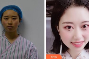 唐山聯(lián)合麗珍醫(yī)療美容門診部張德相整形價格表附埋線提升案例展示