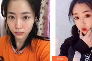 唐山聯(lián)合麗珍醫(yī)療美容門診部樸惠恩整形價格表附超聲提拉案例展示