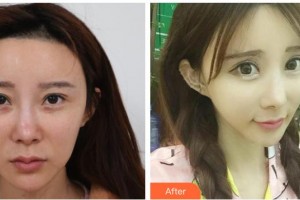 唐山聯(lián)合麗珍醫(yī)療美容門診部金泰憲整形價格表附埋線提升案例展示