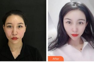 唐山星范醫(yī)療美容門診部王海艷整形價格表附埋線提升案例展示