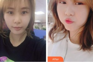 唐山祥云京城皮膚醫(yī)院董春蒼整形價格表附埋線提升案例展示