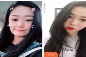 唐山煤醫(yī)整形美容醫(yī)院陳俊蕊整形價格表附埋線提升案例展示