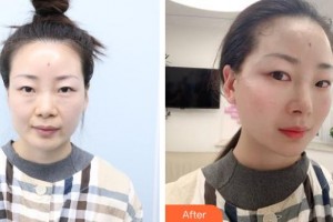 唐山煤醫(yī)整形美容醫(yī)院馬文超整形價格表附埋線提升案例展示