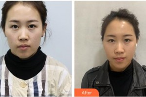 唐山聯(lián)合麗珍醫(yī)療美容門診部金燦棕整形價格表附埋線提升案例展示