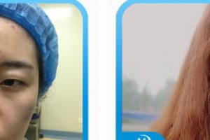 唐山光明醫(yī)院高澤明整形價格表附開內(nèi)眼角案例展示