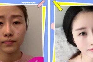 唐山光明醫(yī)院宋東軍整形價格表附切開雙眼皮案例展示