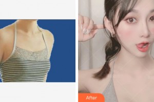 武漢伊萊美醫(yī)療美容門診部余國勝整形價格表附自體脂肪豐胸案例展示