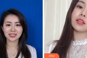 武漢正璞醫(yī)療美容門診部陳華艷整形價格表附牙齒矯正案例展示