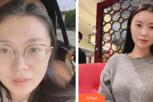 武漢漢秀醫(yī)學美容醫(yī)院吳明瑞整形價格表附自體脂肪填充案例展示