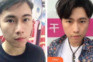 秦皇島紀(jì)輝整形美容醫(yī)院湯旭整形價格表附清潔祛痘案例展示