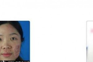 秦皇島紀(jì)輝整形美容醫(yī)院金翰相整形價格表附清潔祛痘案例展示