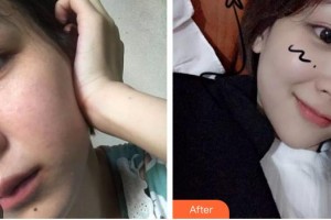 秦皇島紀(jì)輝整形美容醫(yī)院高明國整形價格表附光子嫩膚案例展示