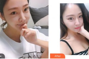 秦皇島紀(jì)輝整形美容醫(yī)院莊琳整形價格表附光子嫩膚案例展示