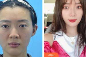 秦皇島紀(jì)輝整形美容醫(yī)院江川整形價格表附埋線提升案例展示