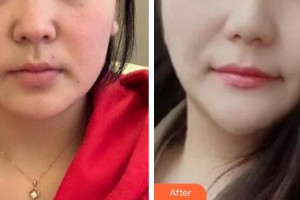 秦皇島友誼醫(yī)院整形美容外科訾海濤整形價格表附埋線提升案例展示