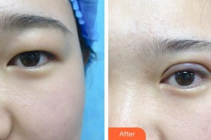 秦皇島紀輝整形美容醫(yī)院王雷整形價格表附眼部綜合案例展示