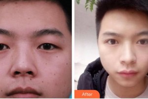 秦皇島念奴嬌醫(yī)療美容門診部馬艷艷整形價格表附切開雙眼皮案例展示