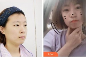 秦皇島念奴嬌醫(yī)療美容門診部康凱整形價格表附切開雙眼皮案例展示