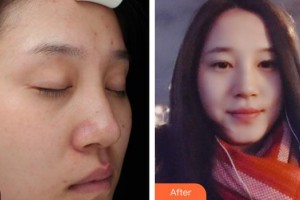 秦皇島巧致美容醫(yī)院咸福實(shí)整形價(jià)格表附祛斑祛痣案例展示