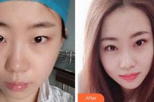 秦皇島匠心醫(yī)美醫(yī)療美容診所謝冰整形價格表附眼部綜合案例展示