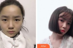 秦皇島和生醫(yī)療美容門診部劉雷整形價格表附眼部綜合案例展示