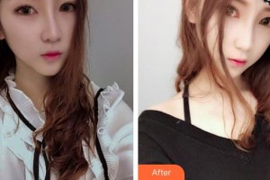 秦皇島愛爾眼科醫(yī)院張一凡整形價格表附埋線雙眼皮案例展示