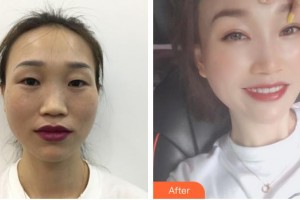 秦皇島愛爾眼科醫(yī)院白玉星整形價格表附眼部綜合案例展示