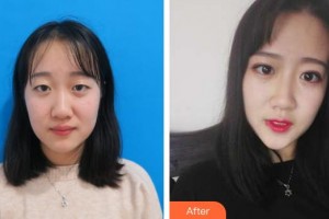 秦皇島巧致整形醫(yī)院楊哲整形價格表附切開雙眼皮例展示