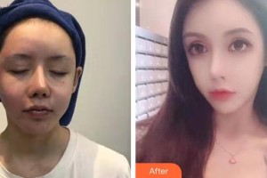 唐山光明醫(yī)院周曉娜整形價(jià)格表附熱瑪吉案例展示