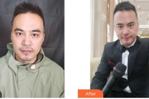 唐山冀東眼科醫(yī)院劉淑偉整形價(jià)格表附內(nèi)切祛眼袋案例展示