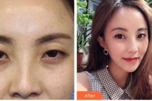 唐山冀東眼科醫(yī)院李春江整形價(jià)格表附眼部綜合案例展示