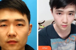 唐山冀東眼科醫(yī)院薛愛君整形價(jià)格表附切開雙眼皮案例展示