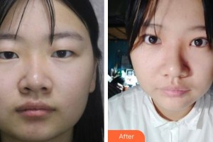 唐山冀東眼科醫(yī)院劉若屏整形價(jià)格表附眼部綜合案例展示