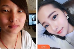 唐山冀東眼科醫(yī)院陳惠茹整形價(jià)格表附定點(diǎn)雙眼皮案例展示