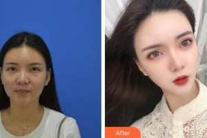 唐山星光醫(yī)療美容門診部彭于賓整形價(jià)格表附激光去眼袋案例展示