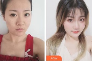 唐山星光醫(yī)療美容門診部劉俊偉整形價(jià)格表附去痘印痘坑案例展示