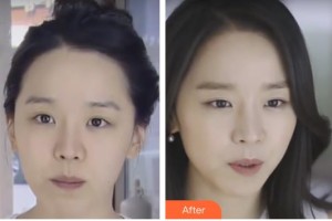 邯鄲都市整形美容醫(yī)院魯樹(shù)榮整形價(jià)格表附激光除皺案例展示