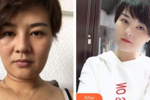 邯鄲曲勝星范醫(yī)療美容門診部曲秀麗醫(yī)師整形價(jià)格表附埋線提升案例展示