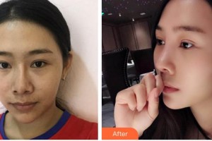 邯鄲韓雅醫(yī)療美容診所楊利民整形價(jià)格表附鼻部綜合案例展示