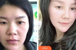 邯鄲京美整形醫(yī)院陳阿喜整形價(jià)格表附鼻骨矯正案例展示