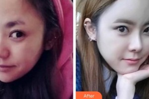 邯鄲現(xiàn)代麗人醫(yī)院整形美容中心姜昌軍整形價(jià)格表附鼻部綜合案例展示