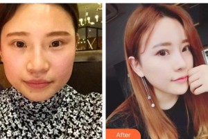 邯鄲現(xiàn)代麗人醫(yī)院整形美容中心陳逸華整形價(jià)格表附肋軟骨隆鼻案例展示