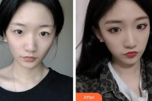 邯鄲華美醫(yī)療美容醫(yī)院許再榮整形價(jià)格表附切開雙眼皮案例展示