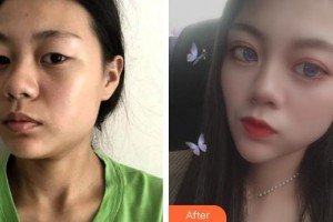 邯鄲雅乾醫(yī)療美容診所侯勝濤整形價(jià)格表附眼部綜合案例展示