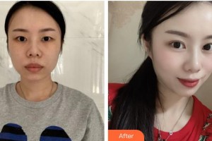 邯鄲雅麗醫(yī)療美容門診部常英敏整形價(jià)格表附眼部綜合例展示