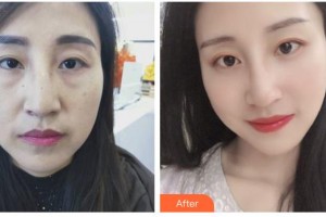 邯鄲都市整形美容醫(yī)院董春姬整形價(jià)格表附激光去眼袋案例展示